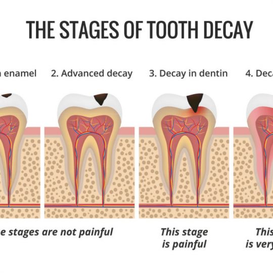 toothdecay-540x540.jpg